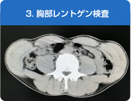 3. 胸部レントゲン検査